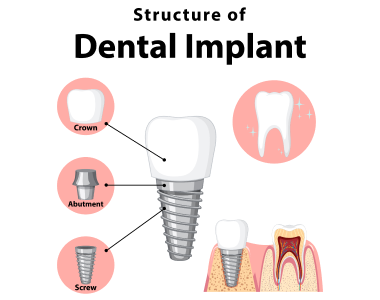 Dental Implants Xenia Ohio